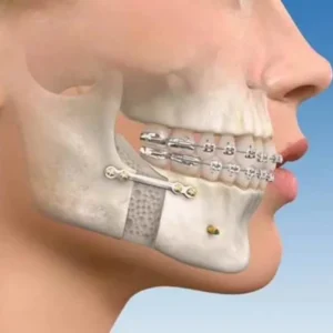jaw fractures treatment