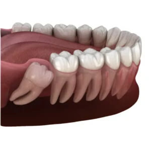Painless wisdom tooth removal
